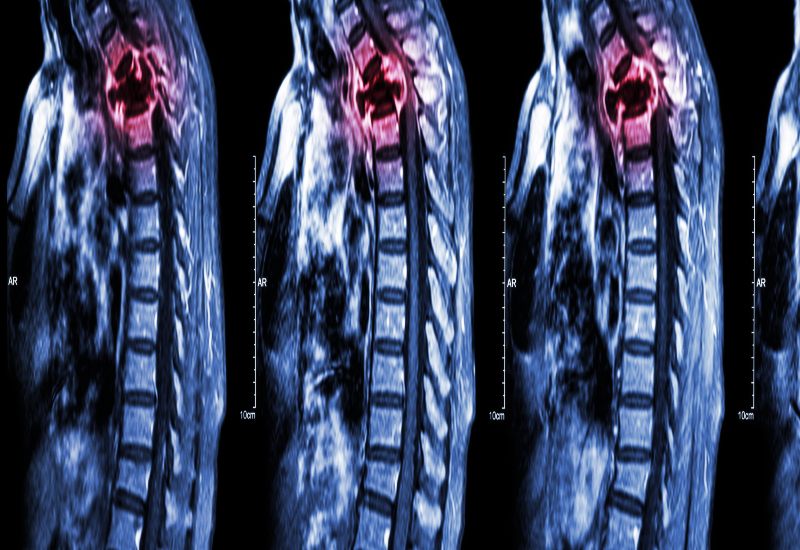 Dr. Salvatore Palumbo is observing an X-ray for a spinal tumor on Long Island