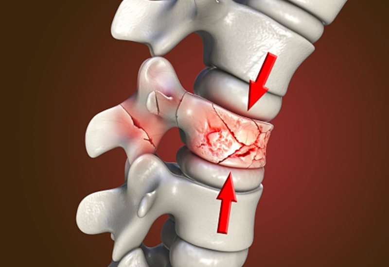 Dr. Salvatore Palumbo is explaining a vertebral compression fracture on Long Island